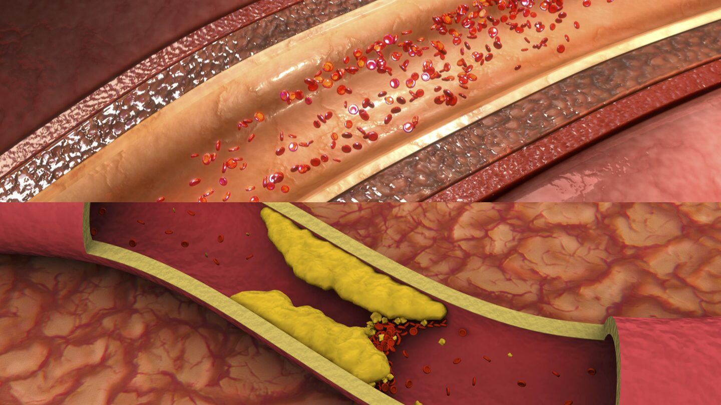 Diagram comparing a healthy artery with an atherosclerotic artery showing plaque buildup, narrowed lumen, and restricted blood flow.